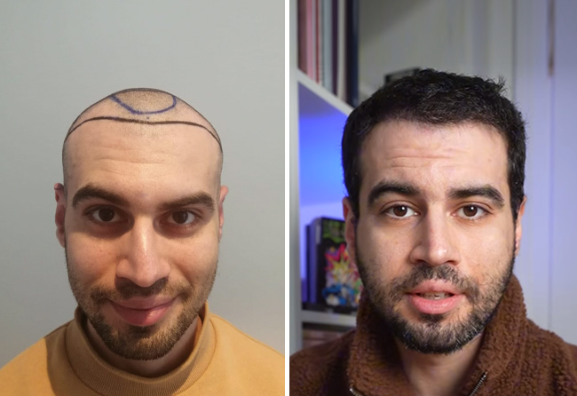 Spybas hair transplant at Elithair