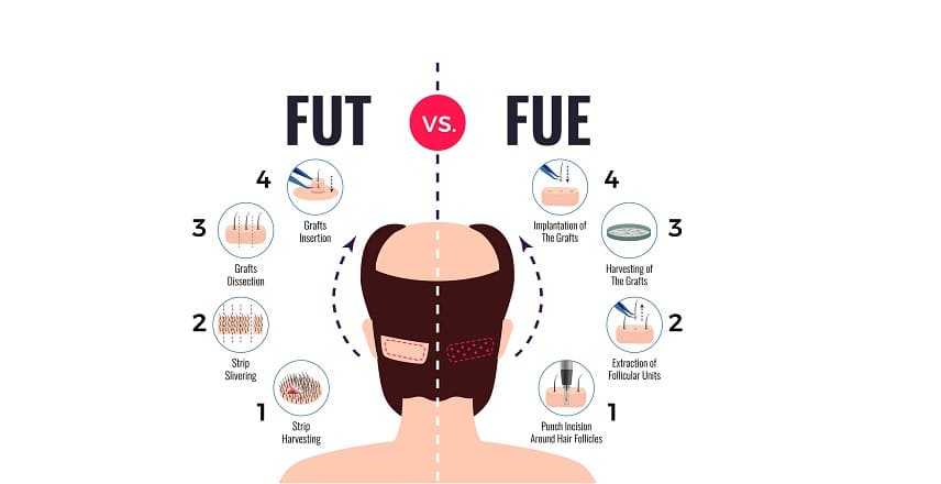 An illustration outlining the differences between FUT and FUE procedures. A balding male figure is seen from behind. On the left side, the FUT procedure is describing in steps featuring strip harvesting, strip slivering, grafts dissection, and grafts insertion. On the right side, the FUE technique is outlined step-by-step, covering the punch incision around hair follicles, extraction of follicular units, harvesting of the grafts, and implantation of the grafts.