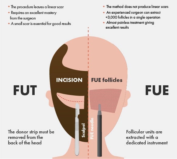 The FUT method of hair transplants is older than the FUE and used to leave a scar