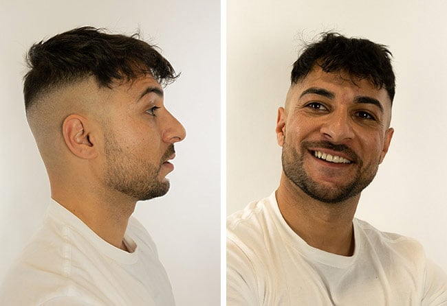 Image after hair transplant sapphire 2200 grafts osamani perparim