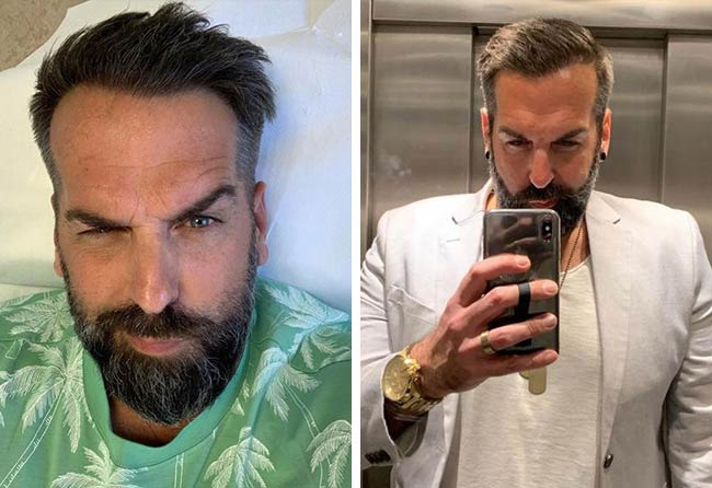 Image after hair transplant sapphire 3400 grafts 10 months juergen t