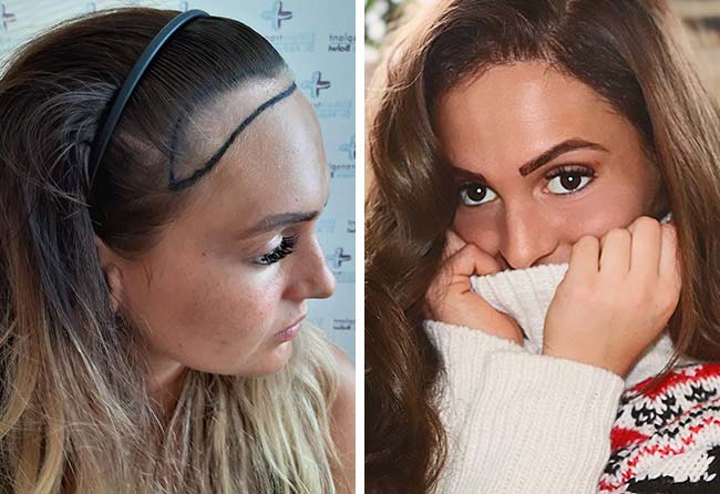 image before after hair transplant women SDHI 2200 grafts karin baumann