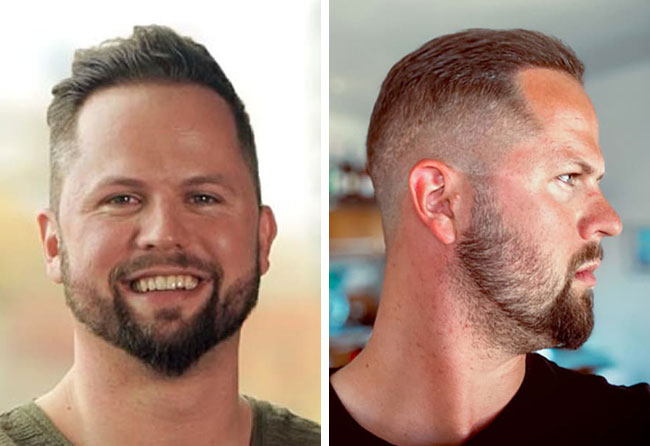 image result hair transplant sapphire 3200 grafts nico gumlich