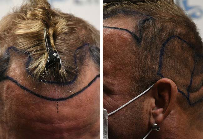 image before hair transplant DHI 2900 grafts hollywood matze