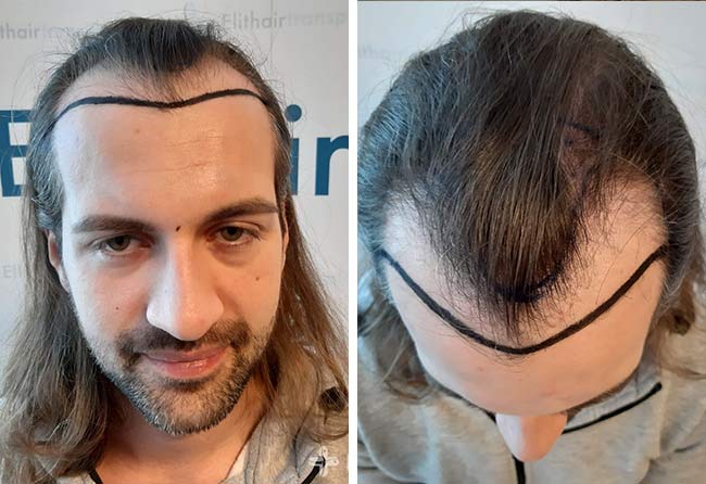 Pitcure Before sapphire hair transplantation 4000 grafts Cagatay Tuerkseven