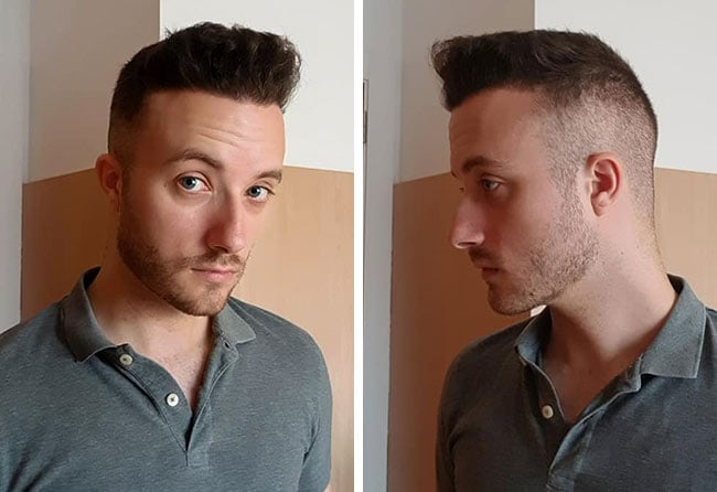 Picture result sapphire hair transplantation 4500 grafts Didac Scheffler