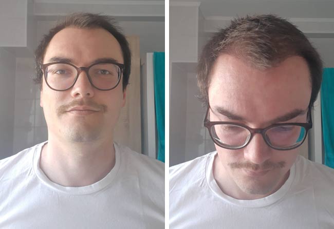 Picture Before dhi hair transplantation 3500 grafts Chris Scholz after 3 months