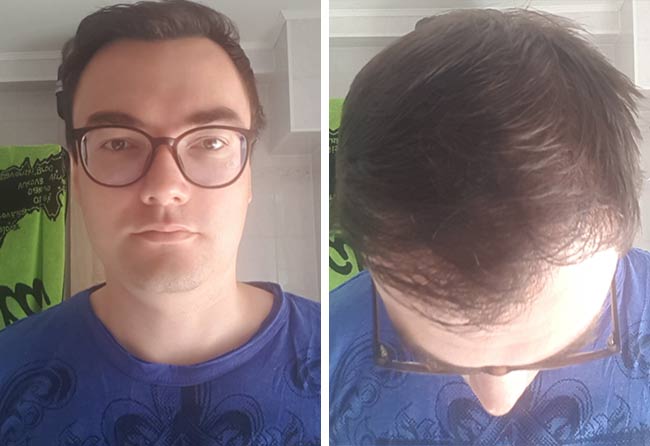 Picture Before dhi hair transplantation 3500 grafts Chris Scholz after 5 months