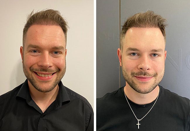Picture before after dhi hair transplantation 4700 grafts Michael Simma after 5 months