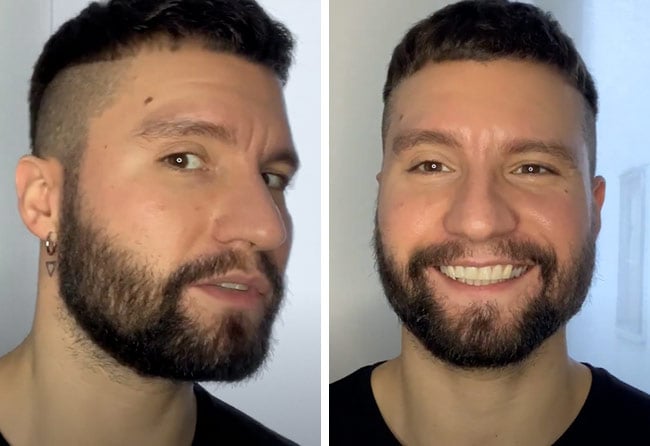 Picture before after sapphire beard transplantation 3500 grafts Dominik Schmitz after 4 months