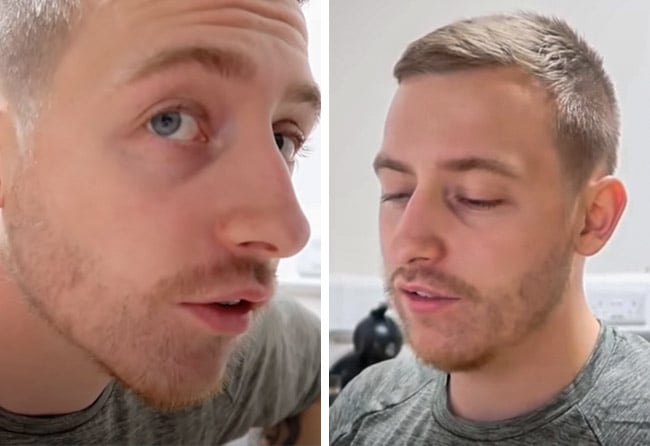 Picture before after sapphire beard transplantation 4200 grafts Jay Jones after 2 months