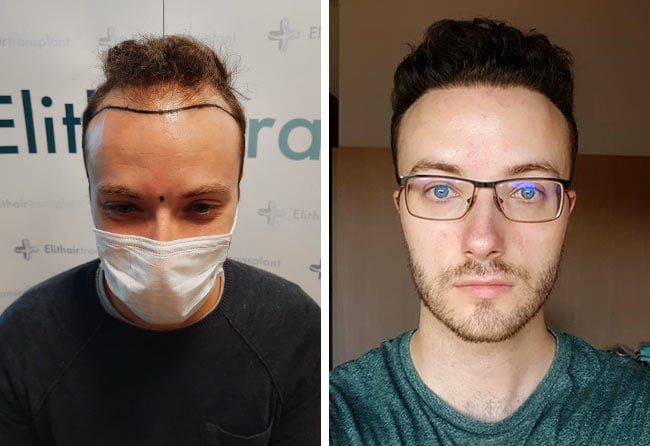 Picture before after sapphire hair transplantation 4500 grafts Didac Scheffler