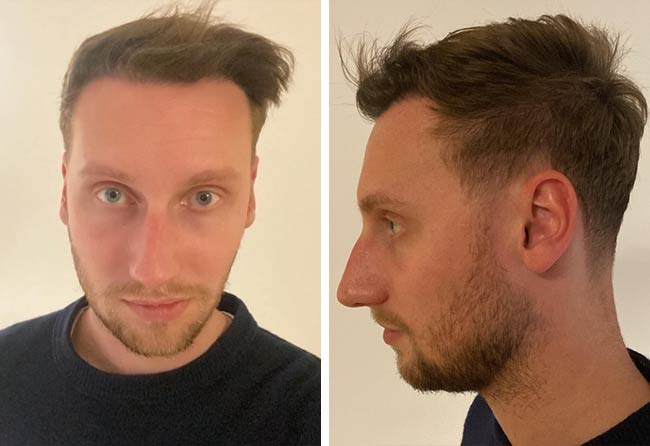 Picture result dhi hair transplantation 3950 grafts Oliver Dietrich
