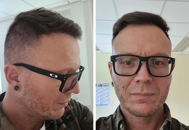 Picture result dhi hair transplantation 4500 grafts Steffen Kraeuter