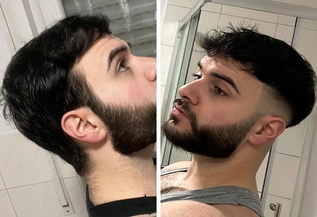 Picture result dhi hair transplantation 4700 grafts Okan Yueksel