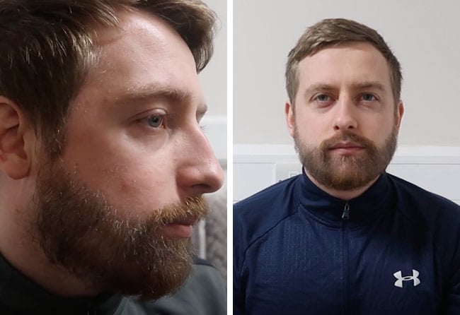 Picture result sapphire beard transplantation 4200 grafts Jay Jones