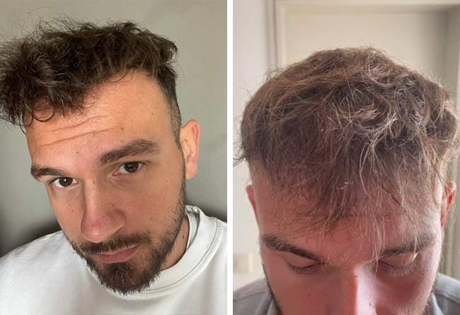 Picture result sapphire hair transplantation 4500 grafts Sefket Ahmetovic