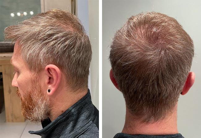 Raffaele-Leucci-after-crown-DHI-hair-transplantation-4750-grafts