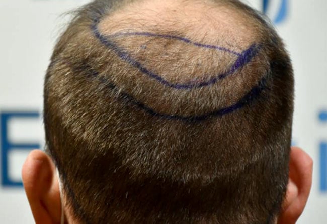 Patrick Bertram before sapphire hair transplantation 4700 grafts