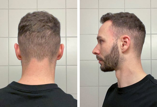 after dhi hair transplantation crown 4700 grafts Kriss Kross