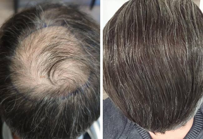 before after sapphire hair transplantation crown 3100 grafts Daniel