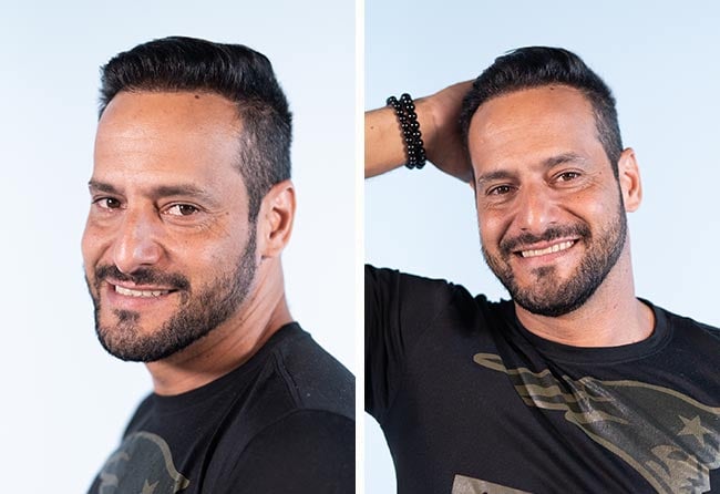 Picture of the result for the sapphire hair transplantation with 3500 grafts of Rawderson Amaral