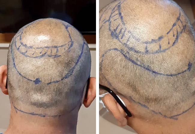 Before the operation DHI hair transplant 4000 grafts Shahid A