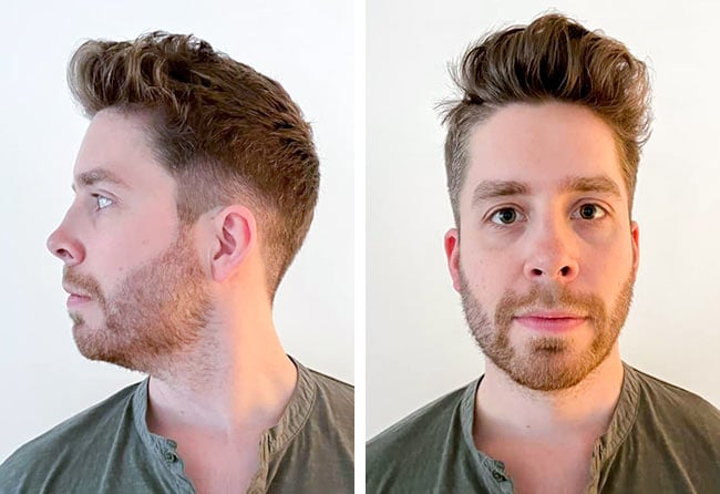 Before Sapphire beard transplant 3200 grafts Eike R 4 Months