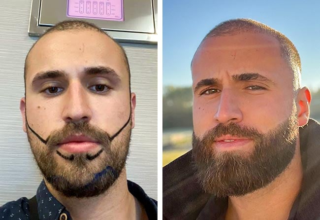 Before and after sapphire beard transplant 3300 grafts Hu Le