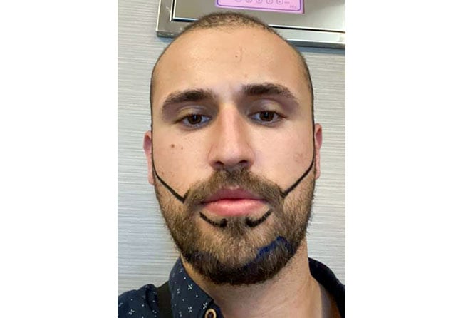 Before sapphire beard transplant 3300 grafts Hu Le