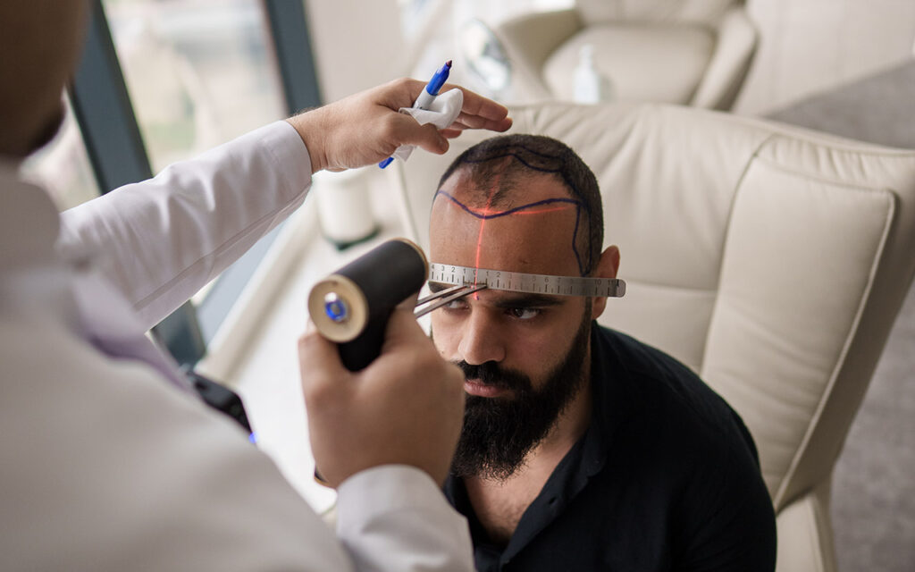 Specialist drawing the hairline on a patient’s scalp before hair transplant surgery to plan a natural-looking result