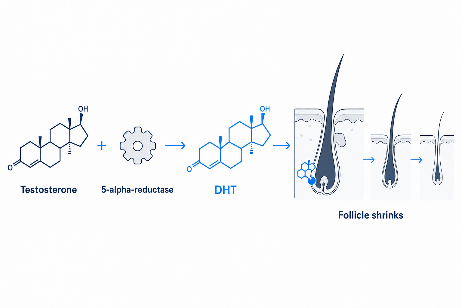 How testosterone converts to DHT and shrinks hair follicles