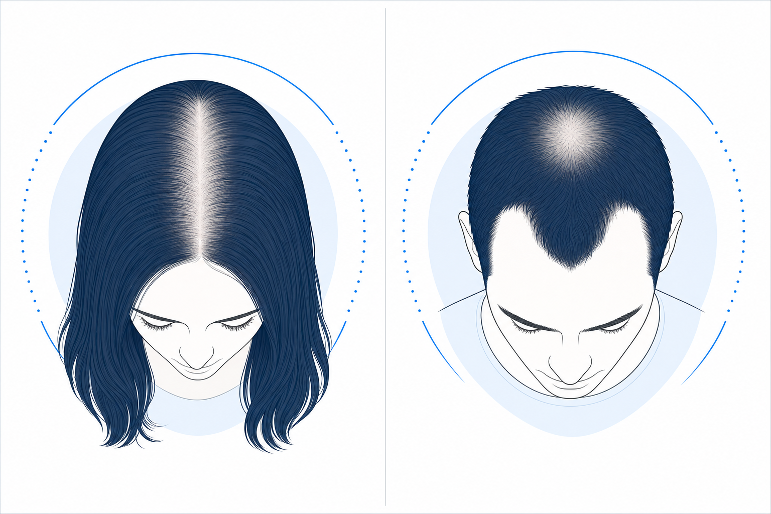 Hair loss patterns compared: diffuse thinning along the central parting in women, receding temples and tonsure in men