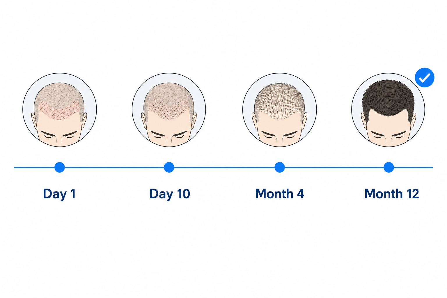Healing timeline after a hair transplant without shaving, from day 1 to month 12