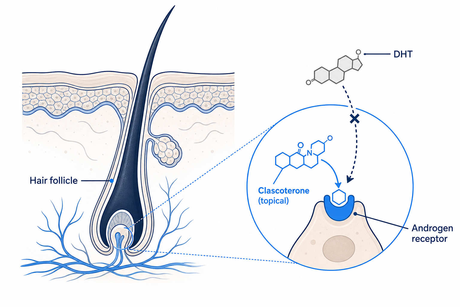 Illustration: clascoterone blocks the androgen receptor at the hair follicle and displaces DHT