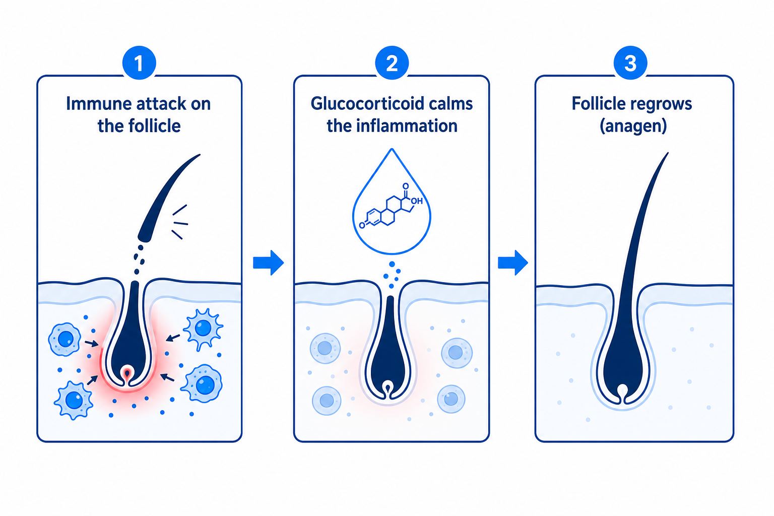 Infographic: how glucocorticoids calm the immune attack on the hair follicle and allow regrowth
