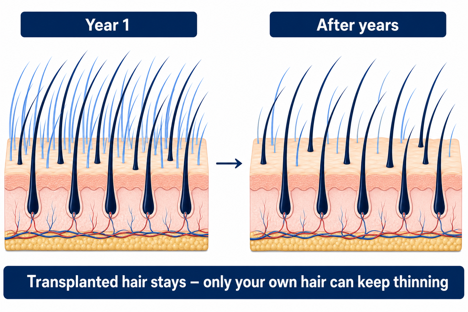 Transplanted hair stays permanently; only the native hair in between can continue to thin over the years
