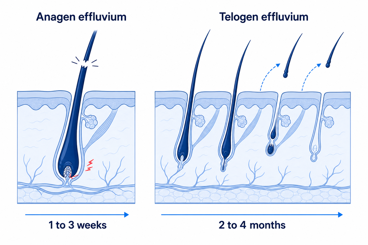 Comparison of anagen and telogen effluvium: hair breakage in the growth phase after 1 to 3 weeks versus diffuse shedding in the resting phase after 2 to 4 months