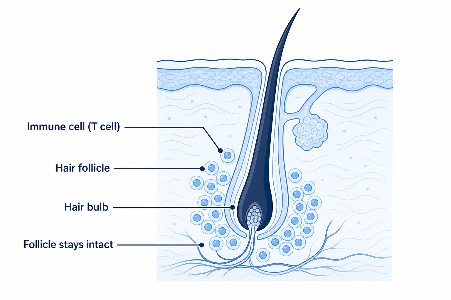 Autoimmune mechanism in alopecia areata: immune cells attack the hair bulb while the follicle stays intact