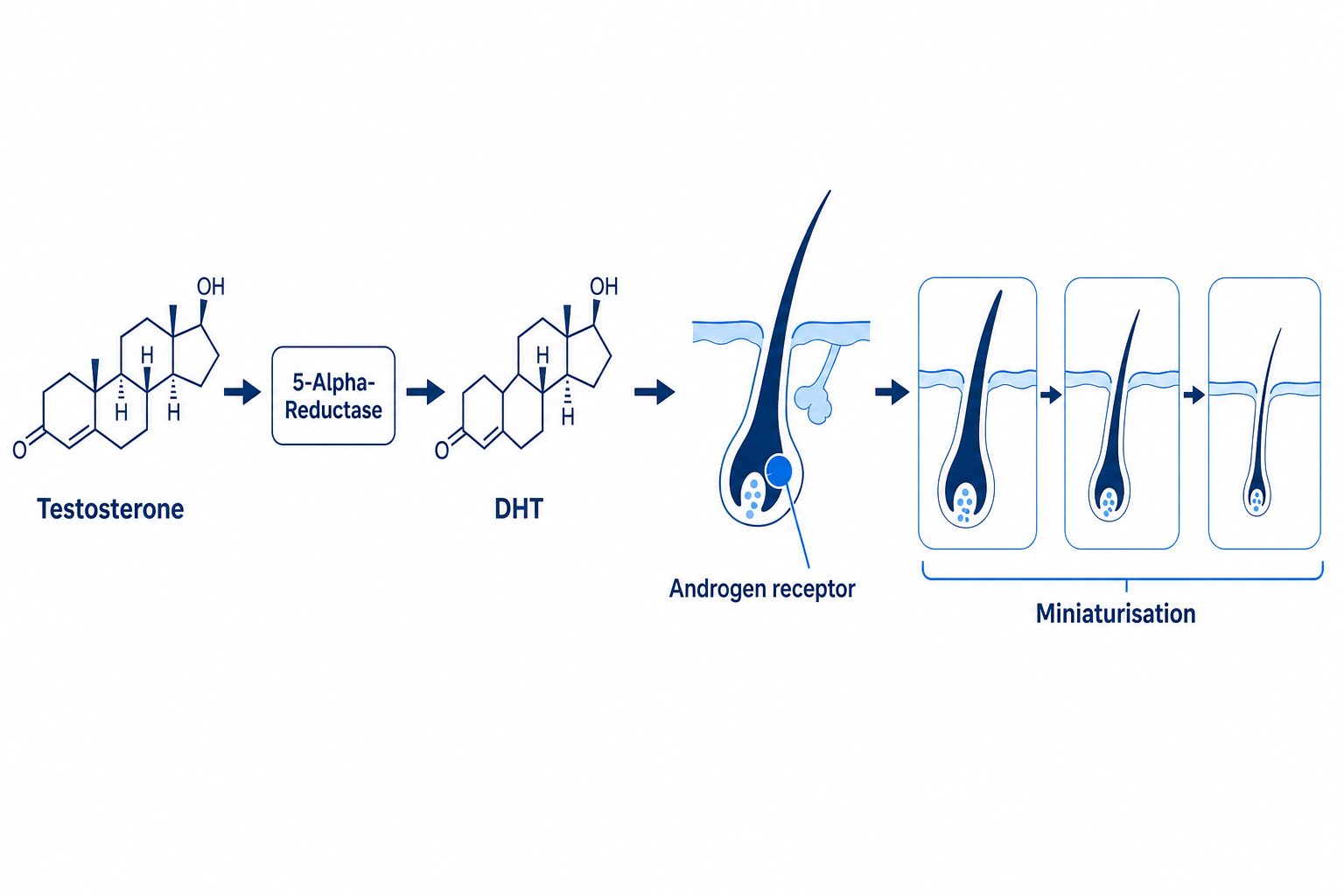 Diagram of the DHT pathway: testosterone, 5-alpha-reductase, DHT and miniaturisation of the temple follicle