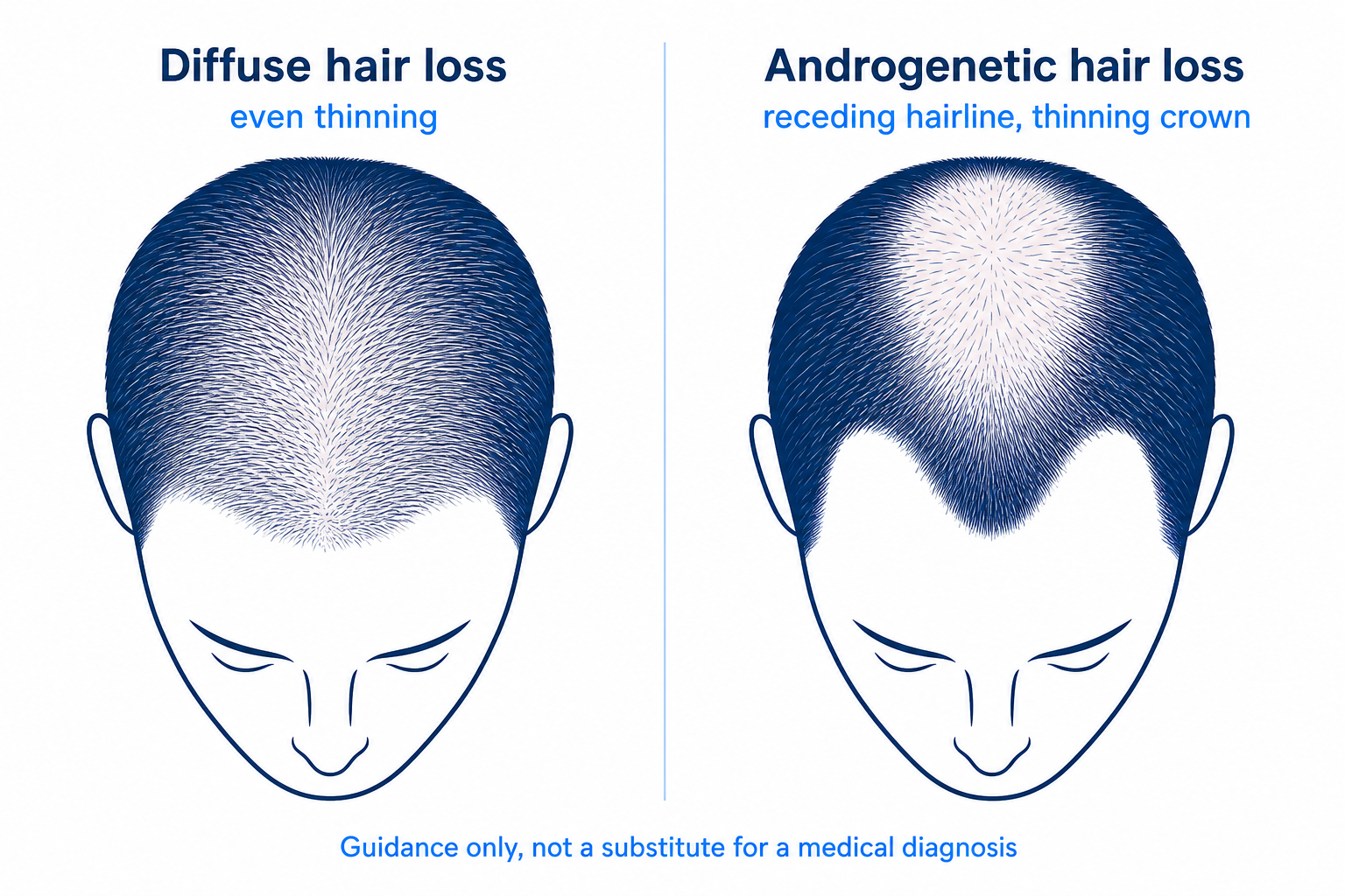 Comparison diagram of diffuse versus androgenetic hair loss, two head silhouettes showing the thinning pattern