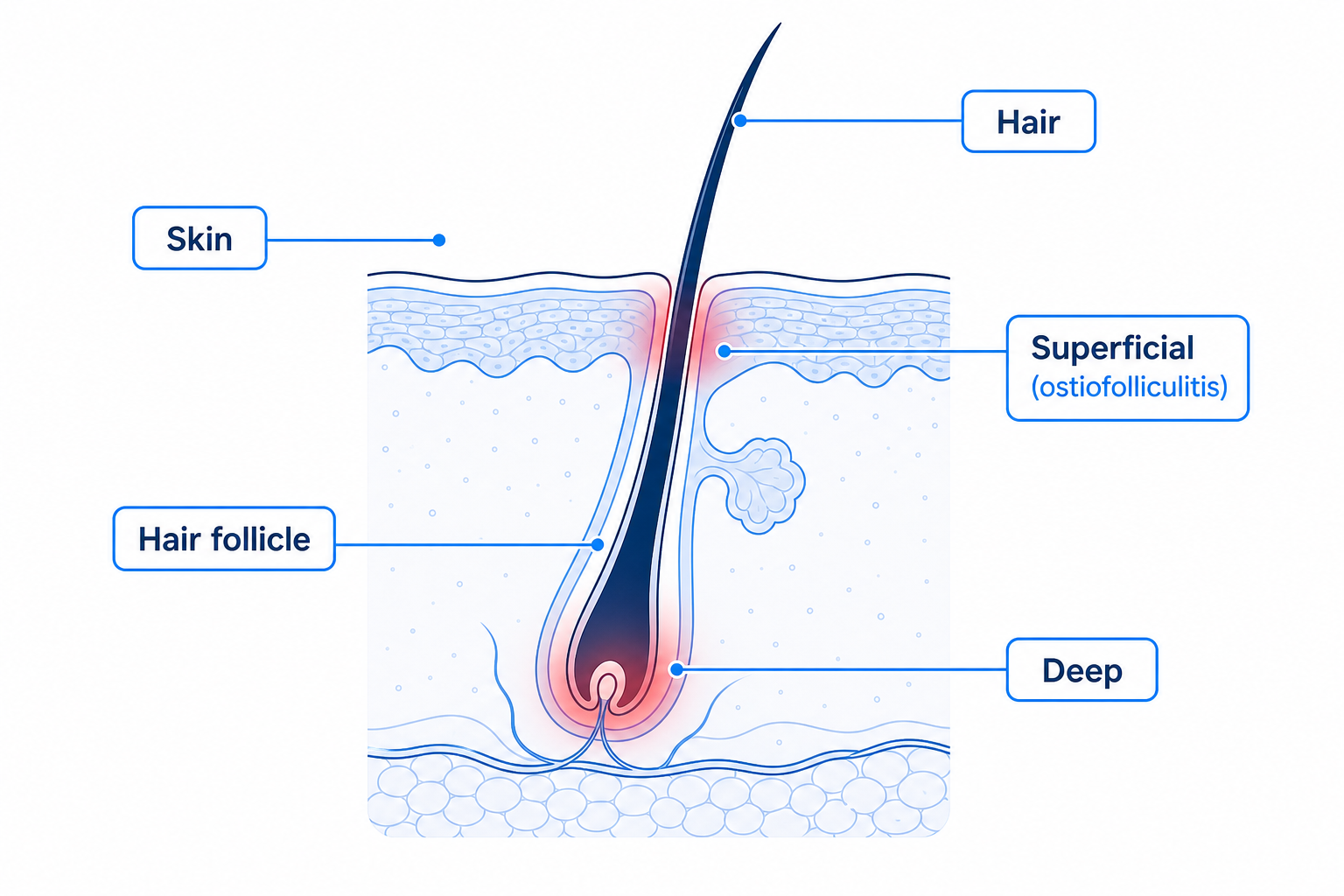 Cross-section of a hair follicle showing a superficial and a deep inflammation zone