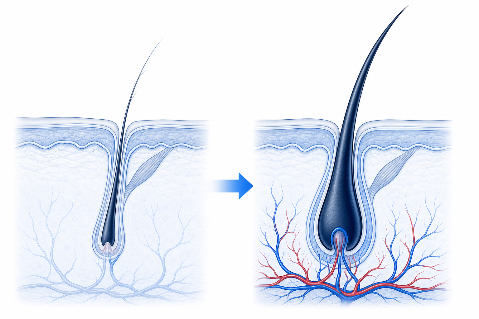 Cross-section comparison of a miniaturised and a revitalised hair follicle