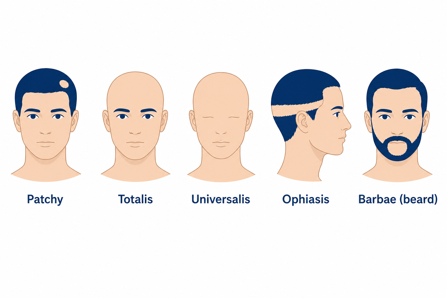 Forms of alopecia areata: patchy, totalis, universalis, ophiasis and barbae
