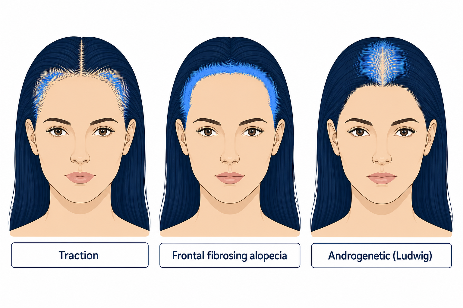Three female head diagrams compared: traction, frontal fibrosing alopecia and the androgenetic Ludwig pattern