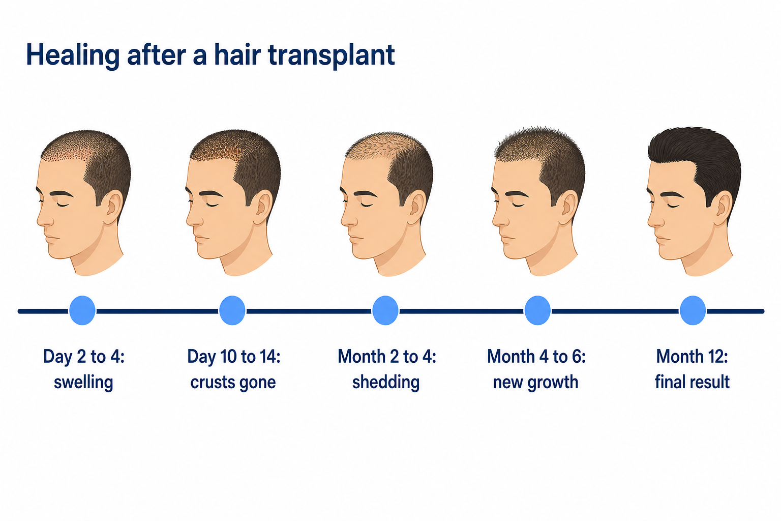 Healing timeline after a hair transplant from day 2 to month 12
