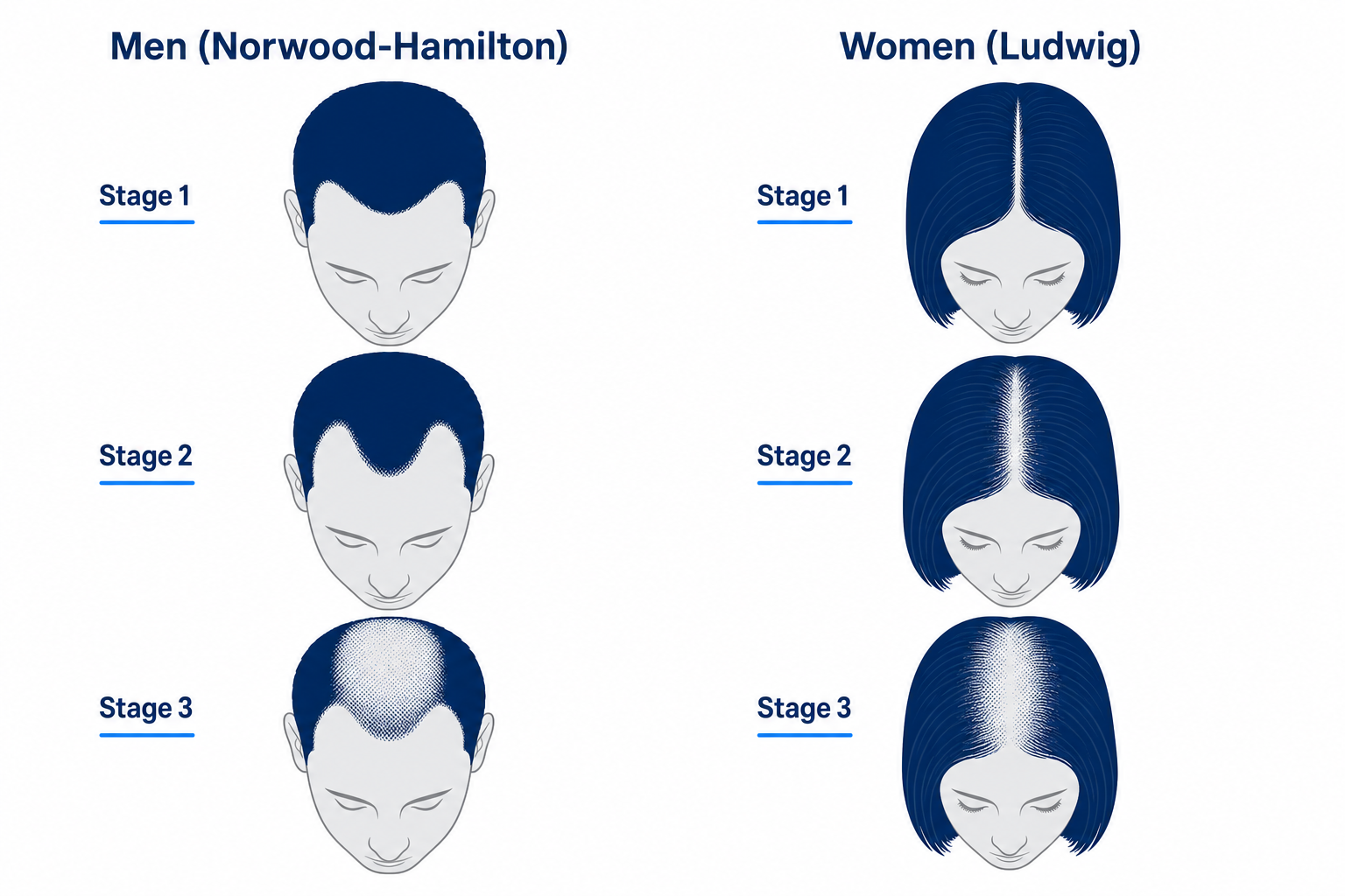 Schematic comparison of hair loss patterns in men (Norwood-Hamilton) and women (Ludwig) in androgenetic alopecia
