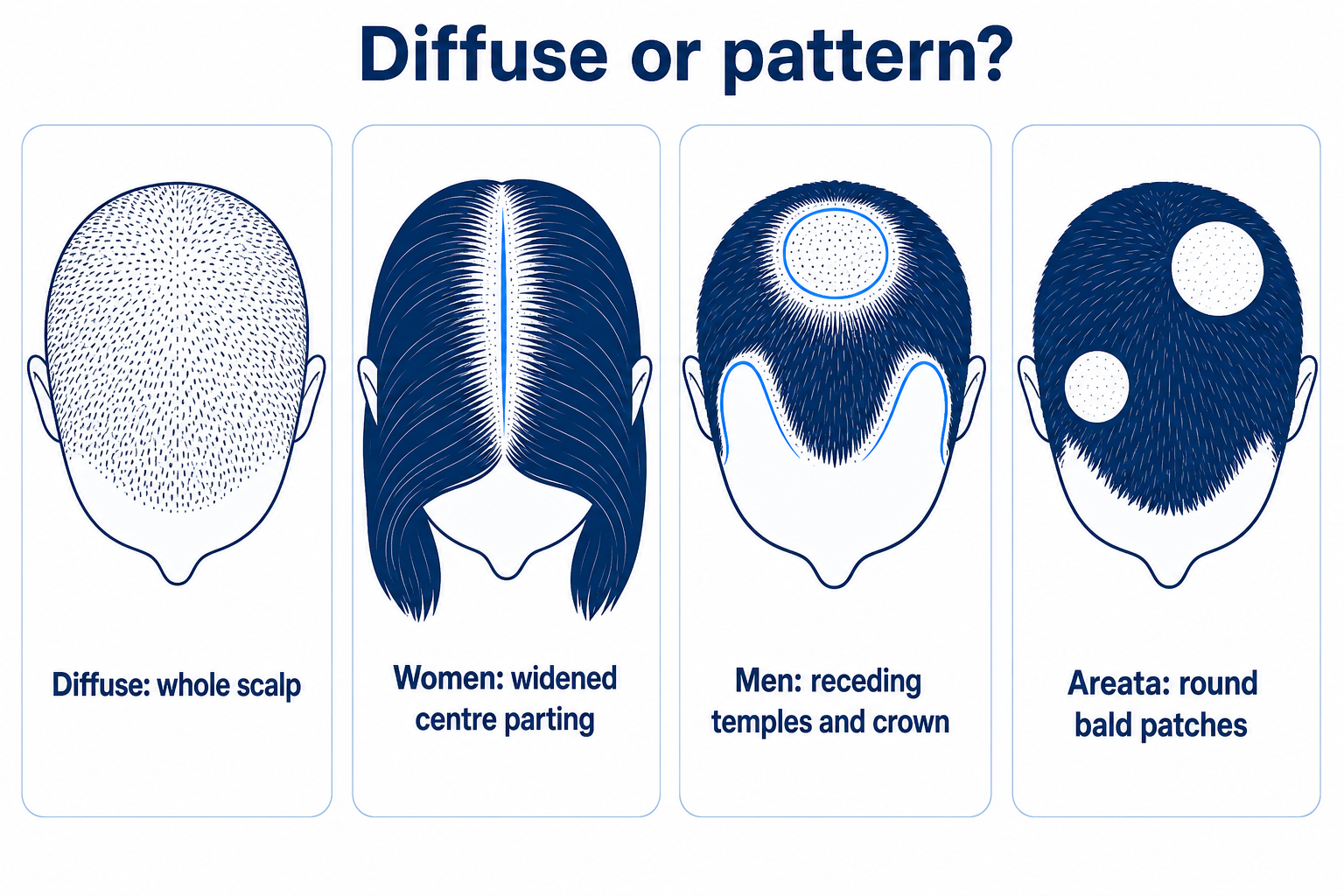Comparison of four hair loss patterns: diffuse thinning across the whole scalp, a widened centre parting in women, receding temples and crown in men, round bald patches in alopecia areata