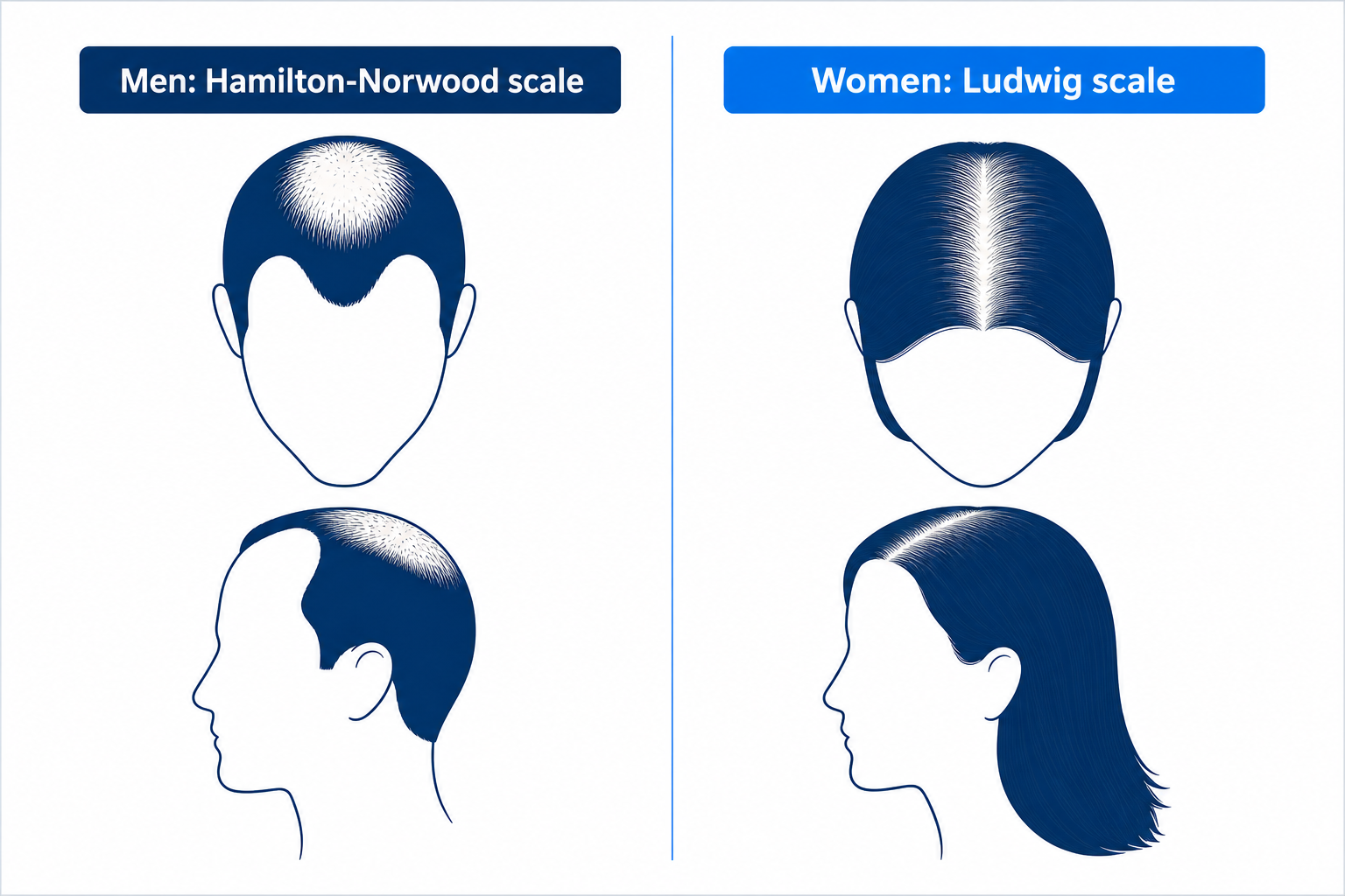 Comparison of the androgenetic hair loss patterns in men (Hamilton-Norwood scale) and women (Ludwig scale) side by side