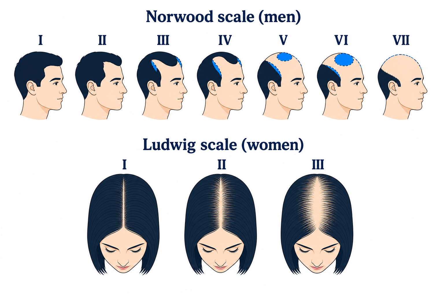 Norwood scale for men and Ludwig scale for women for classifying pattern hair loss